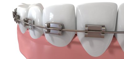 orthodontics Schaumburg